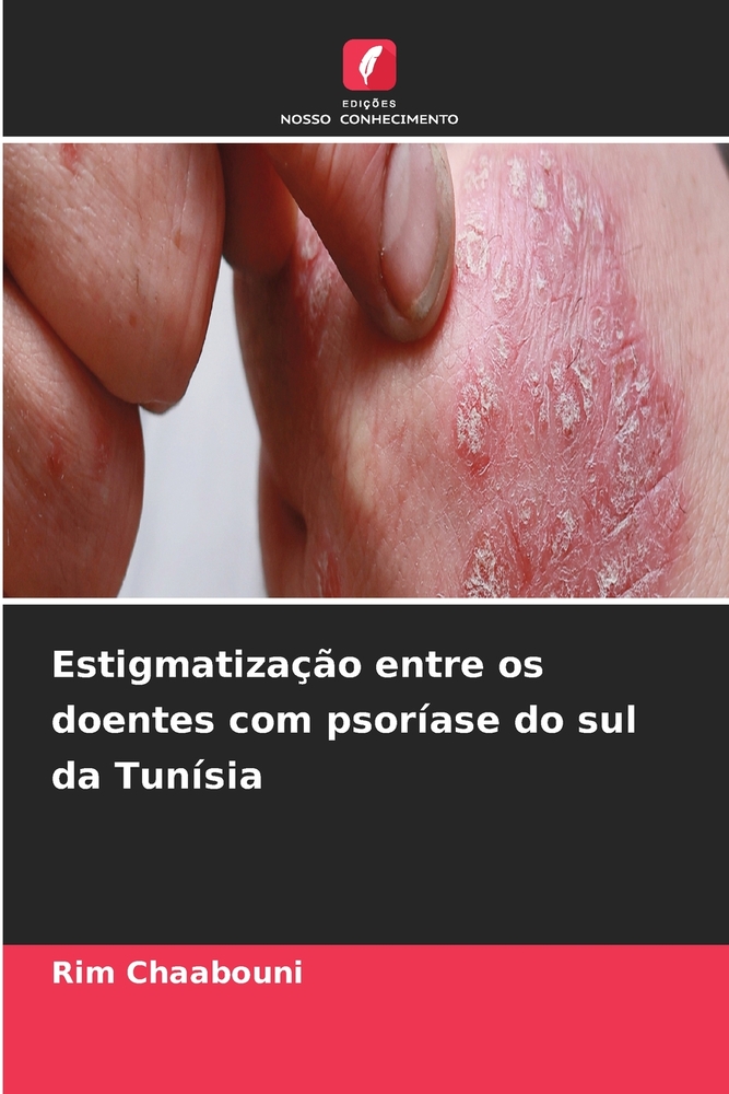 Estigmatização entre os doentes com psoríase do sul da Tunísia cover