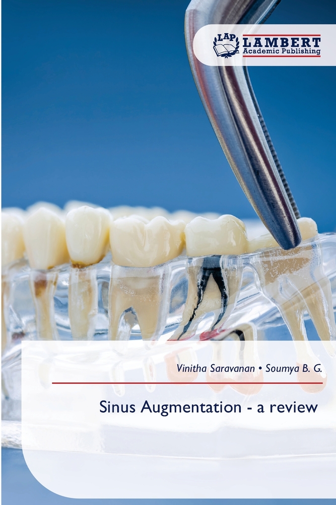 Sinus Augmentation - a review cover