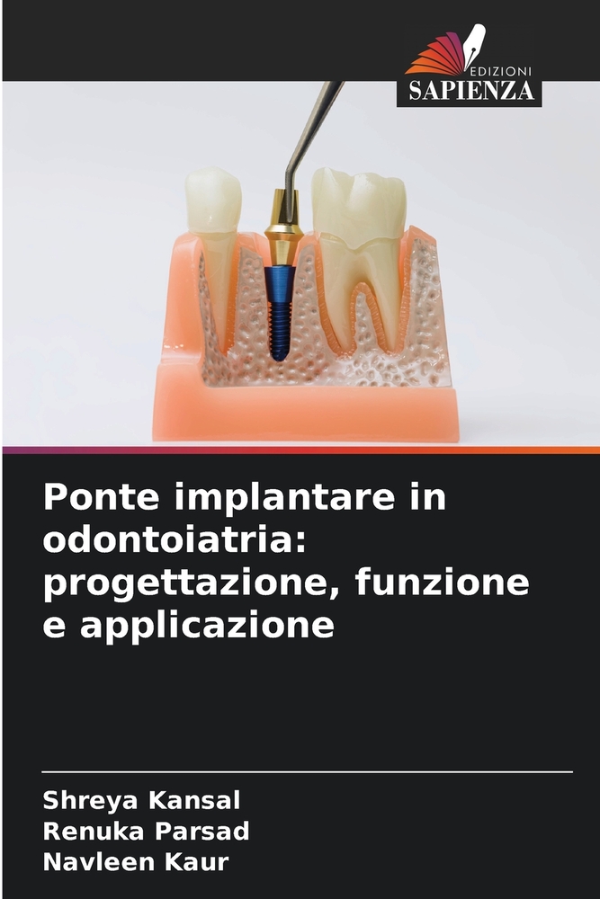 Ponte implantare in odontoiatria: progettazione, funzione e applicazione cover